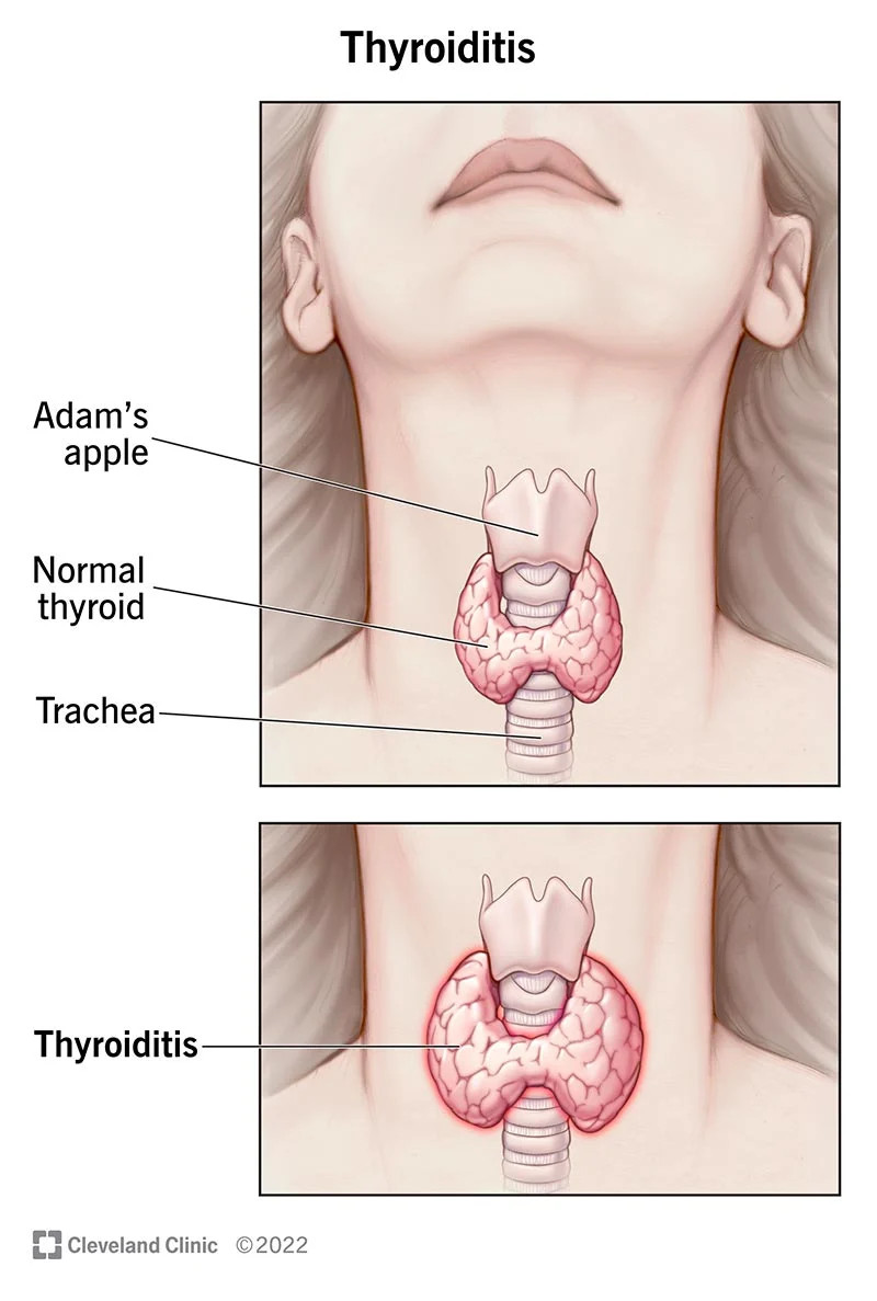 penyakit-tiroiditis-definisi-penyebab-gejala-dan-tata-laksana-ai