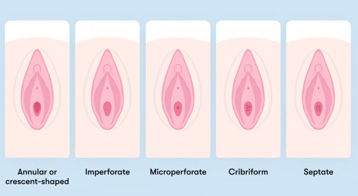 Hymen Imperforata