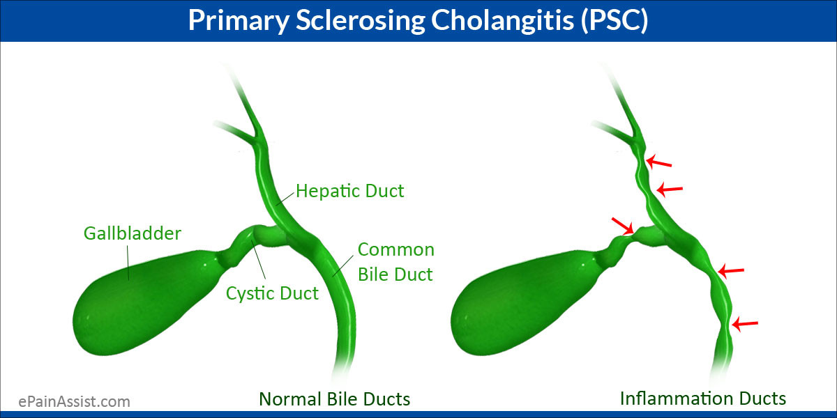 Disease Primary Sclerosing Cholangitis | AI Care