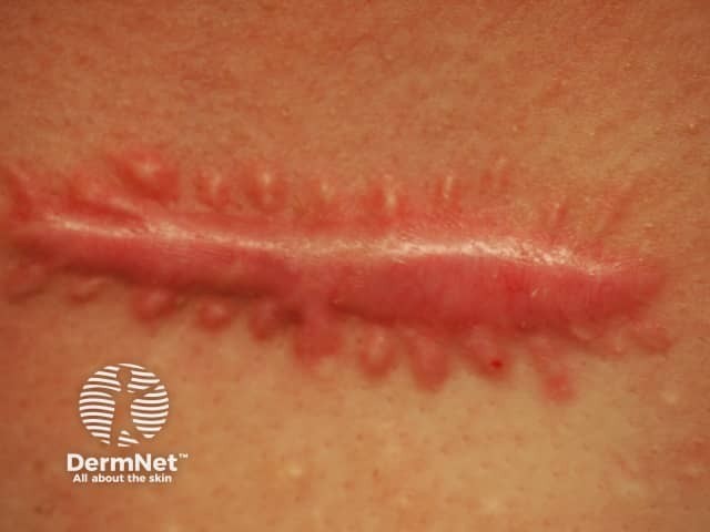 Gambar 1: Keloid. Sumber: dermnetnz.org