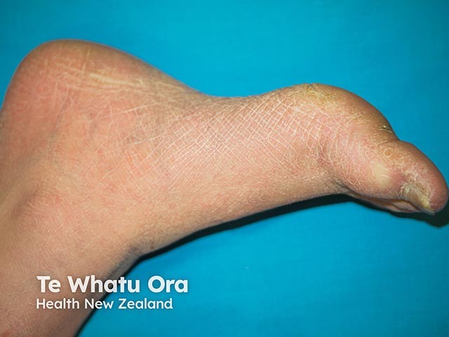 Gambar 1: Hiperkeratosis. Credit: Dermnetnz.org