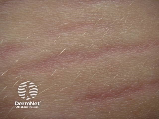 Gambar 1: Stretch Mark. Credit: dermnetnz.org