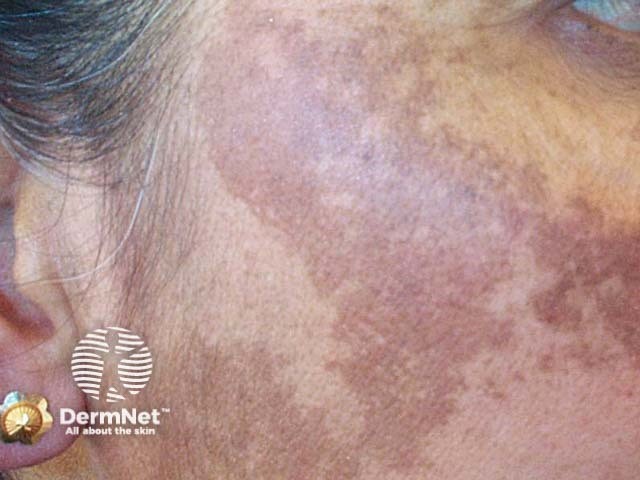 Gambar 1: Melasma. Credit: dermnetnz.org