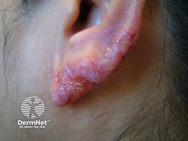 Gambar 1 Lupus Vulgaris. Credit: Dermnetnz