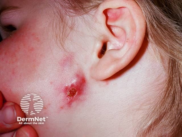 Gambar 2: Skrofuloderma. Credit: dermnetnz