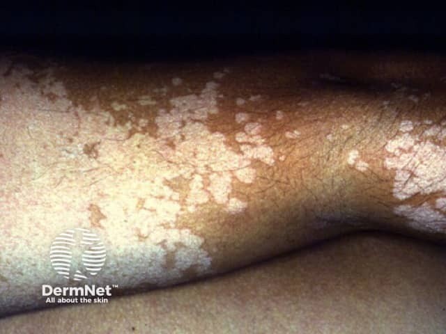 Gambar 1: Tinea Versicolor. Credit: Dermnetnz.org