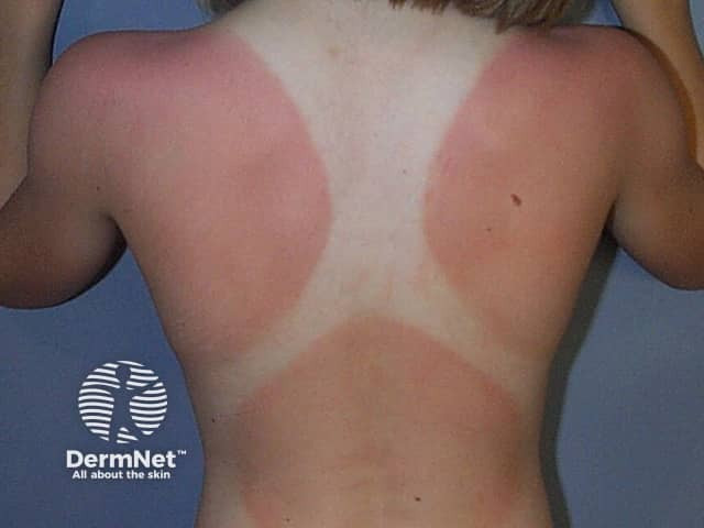 Gambar 1. Sunburn. Copyright: Dermnetnz.org